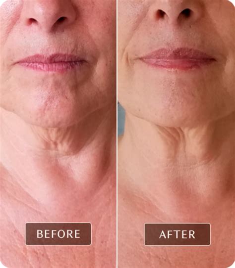 fascia blaster results